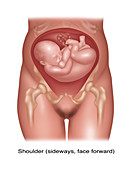 Foetus in Shoulder Position, Illustration