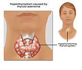 Hyperthyroidism, Illustration