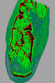 Osteoarthritis in Foot, X-ray