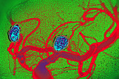 Coil Embolization of Aneurysms, Angiography