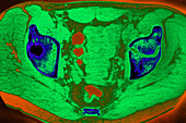 Fracture of Left Pelvis