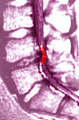 Herniated Disc L4-L5, MRI
