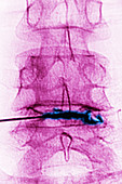 Steroid Injection into Spine, X-ray