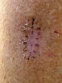 Healing Incision after Skin Cancer Removal