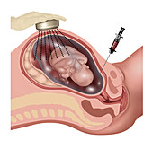 Amniocentesis, Illustration