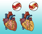 Heart and Artery, Normal vs. Hardened