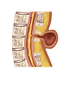 Spina Meningocele, Illustration