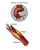 Fat Build up in Artery, Illustration