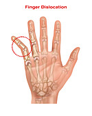 Dislocated Pinky, Illustration