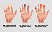 Raynaud's Disease Information Pamphlet