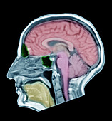 Normal Adult Male Brain, MRI