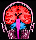 Brain, Sagittal View, MRI