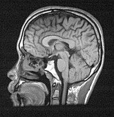 Normal Brain Structures in Head, MRI