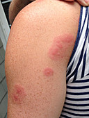 Bed Bug Bites on Arm