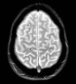 Concussion, Gradient Echo T2, MRI