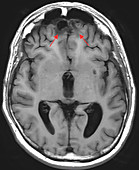 Chronic Post-Traumatic Brain Injury, MRI
