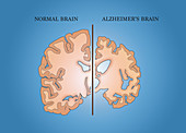 Alzheimer's and Normal Brains, Comparison