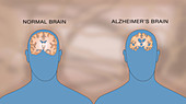 Alzheimer's and Normal Brains, Comparison