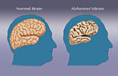 Alzheimer's and Normal Brains, Comparison