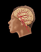 Brain Aneurysm in Situ
