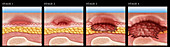 Progression of Pressure Sore