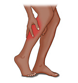 Leg Cramp Common Causes, Illustration