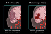 Ischemic & Haemorrhagic Stroke, Illustration