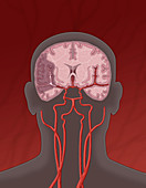 Ischemic Stroke, Illustration