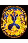 Alzheimer's disease, MRI