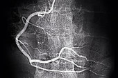 Coronary artery, Angiograph