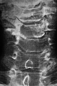 Cervical spondylosis, X-ray