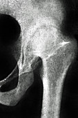 Osteoarthritis, X-ray