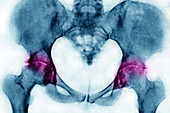 Arthritis of the hips, X-ray