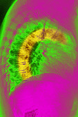 Calcific aortic arch atheroma, X-ray