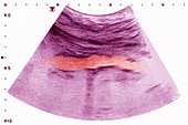 Calcific aortic atheroma, ultrasound