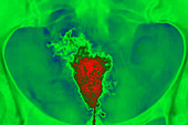 Uterine cancer, X-ray