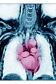 Heart, MRI