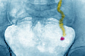 Renal colic, X-ray