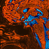 Normal Brain, MRI