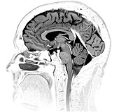 Normal Brain, MRI