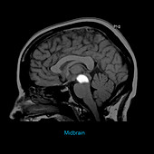 Midbrain, Sagittal MRI