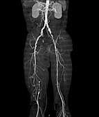 Atherosclerosis, CT angiogram