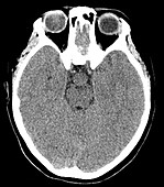 Hypothalamic Hamartoma, CT scan