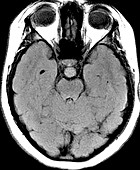 Hypothalamic Hamartoma, MRI