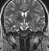 Hypothalamic Hamartoma, MRI