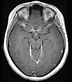 Hypothalamic Hamartoma, MRI