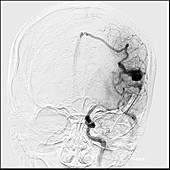 Parietal Lobe AVM, Angiogram
