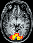 fMRI during Visual Stimulation