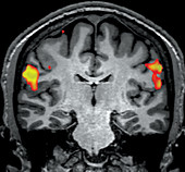 fMRI during Tongue Movement