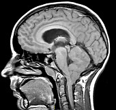 Cerebellar Hemangioblastoma, MRI